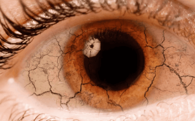 Trockene Augen in den Wechseljahren